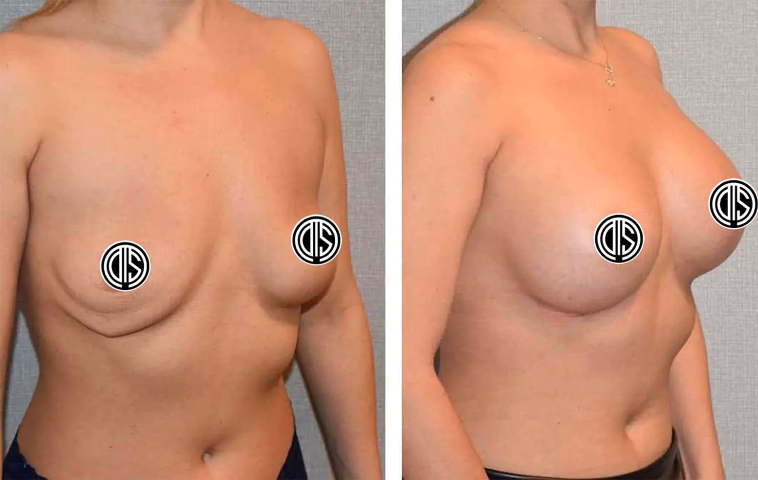 Patient shown before and after replacement of ruptured breast implants.