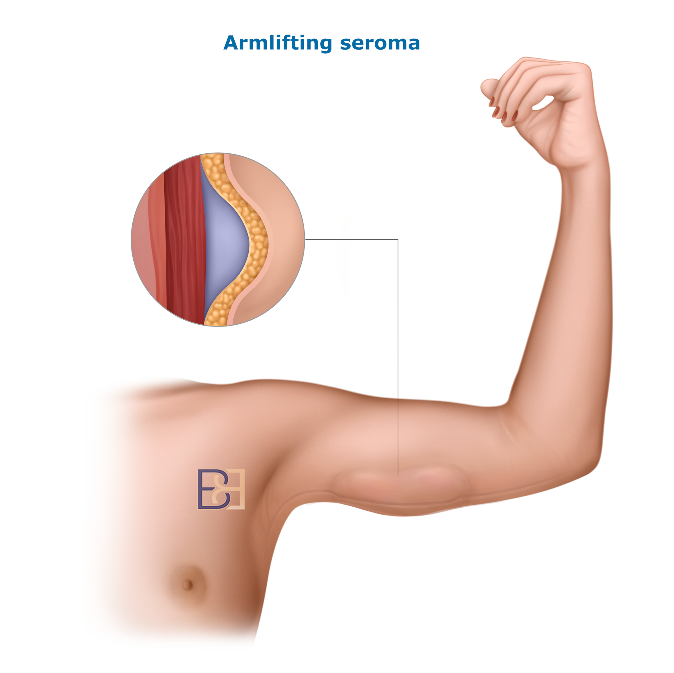 arm seroma