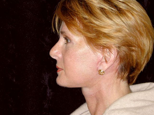 Facelift and Neck lift Surgery - After, same patient in Greenbrae, CA