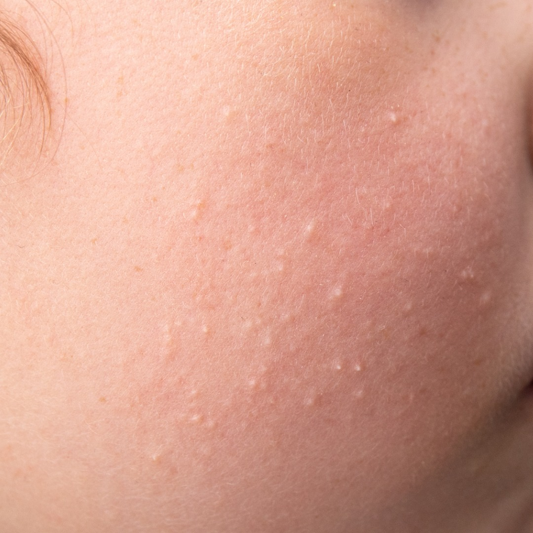 Various skin conditions treated with hyfrecator including skin tags, milia, and sebaceous gland disorders