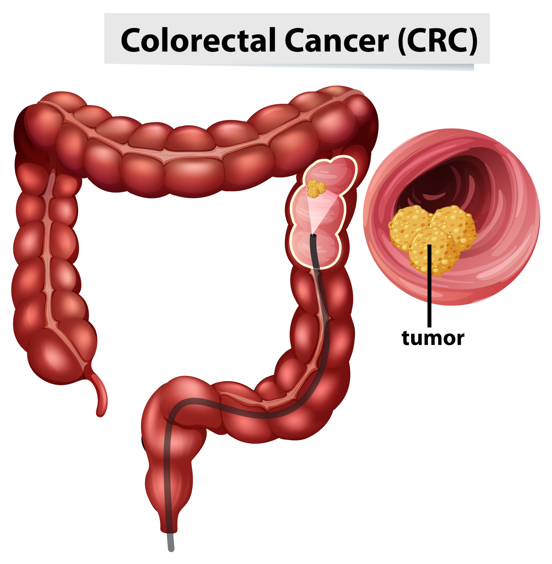 An illustration of bowel cancer.
