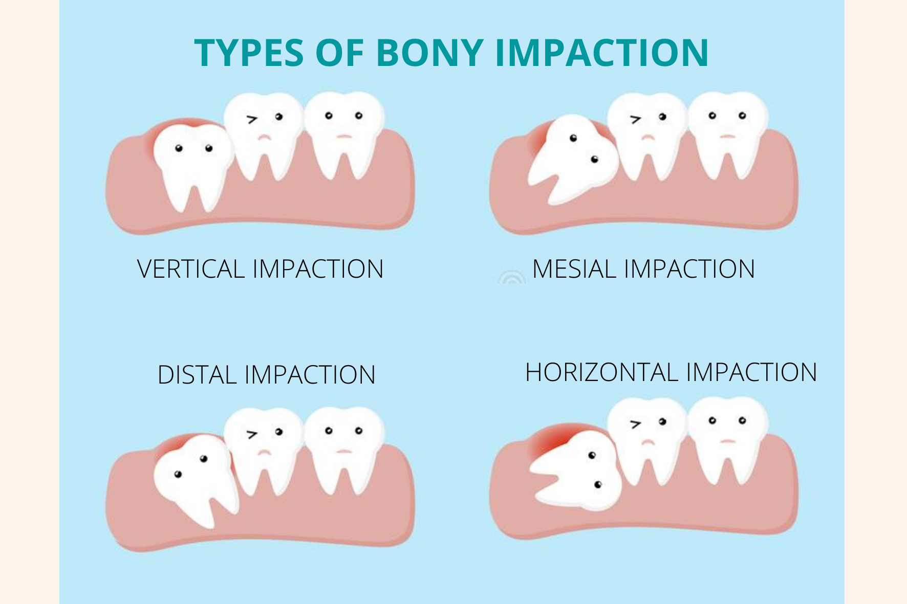 Partially erupted deals wisdom tooth