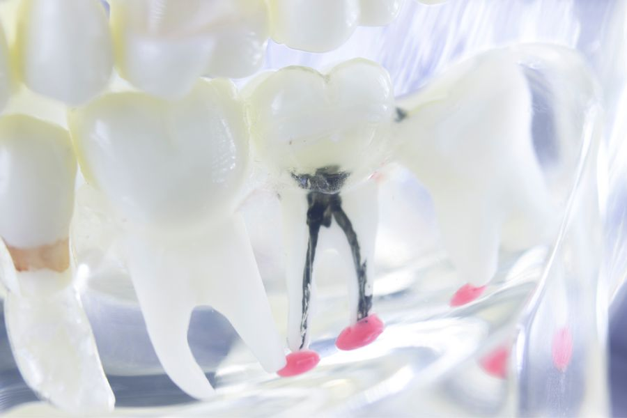 odbudowa korony zęba, leczenie zębów