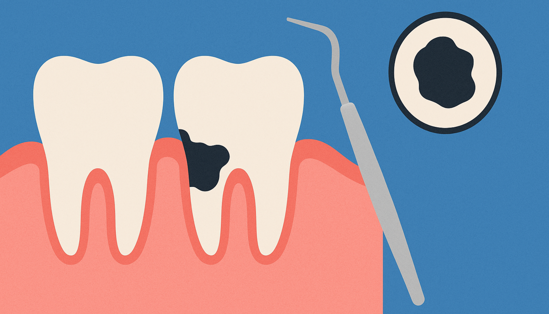 Illustrasjon av svart tannstein på tann langs tannkjøttkanten, med tannrensingsverktøy og forstørrelsesglass ved siden av.