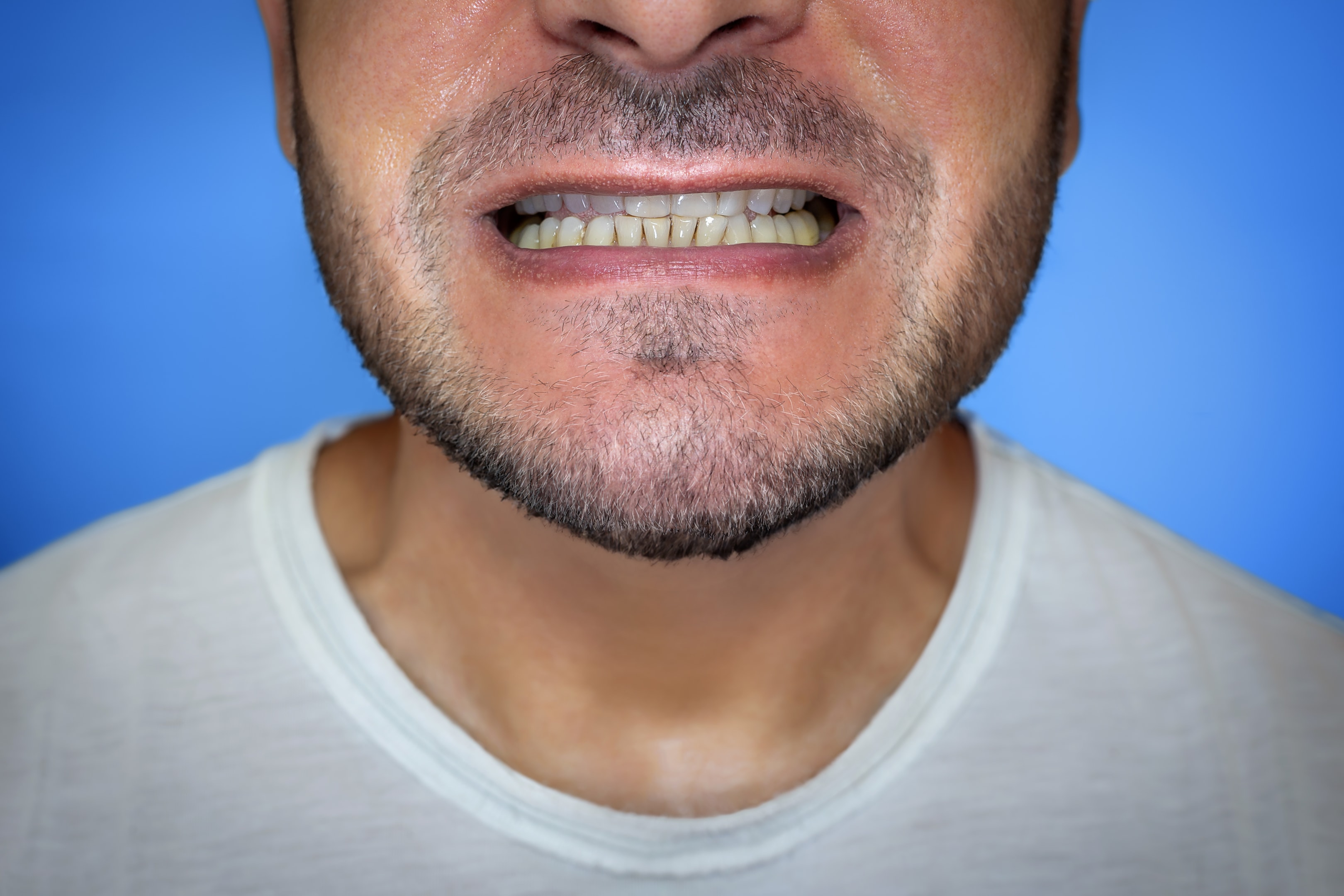 man showing his severe underbite