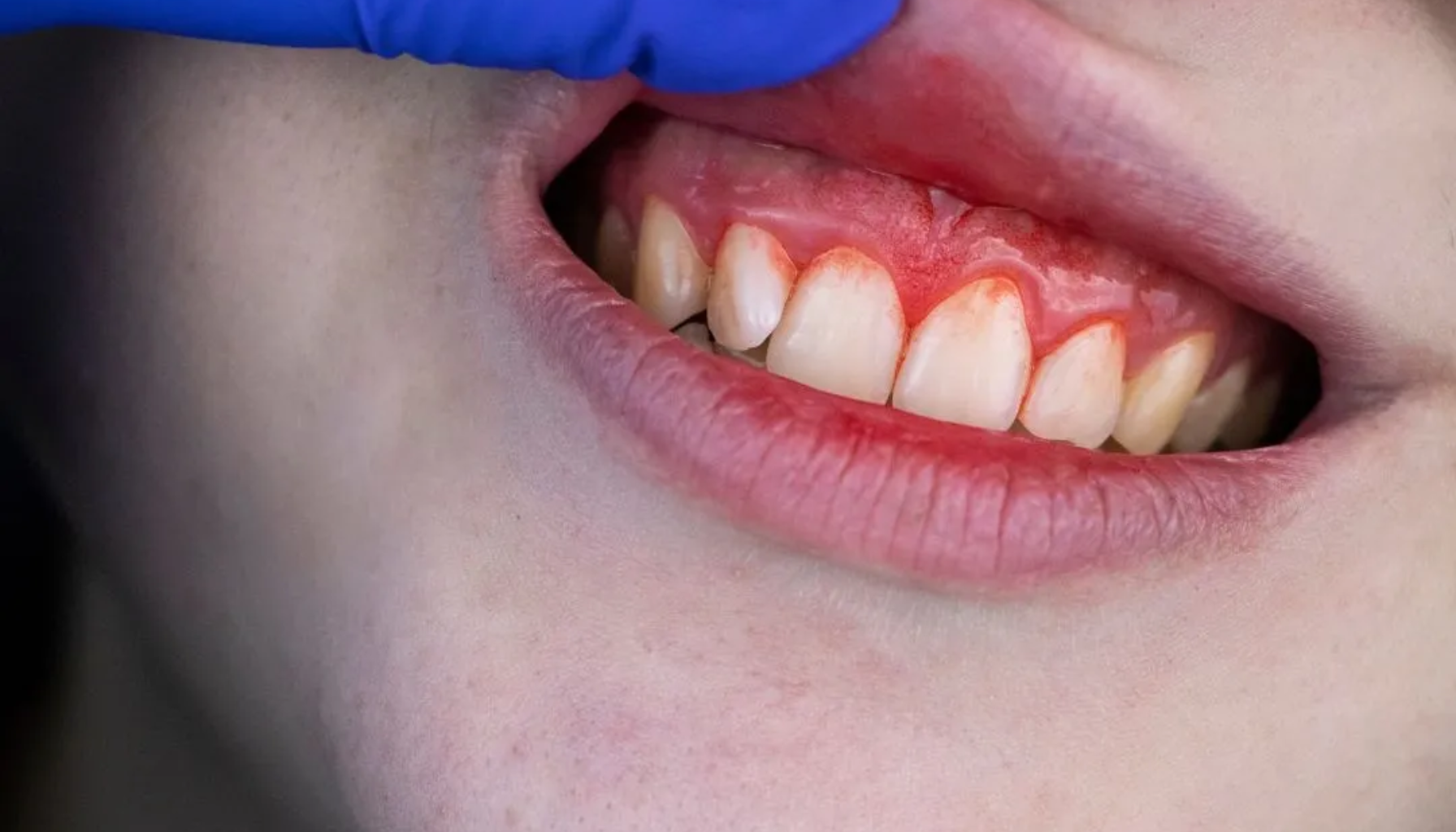 Pyrea Arvelig: Når Genene Øker Risikoen for Tannkjøttsykdom 13 Nærbilde av rødt betent tannkjøtt rundt fortennene, løftet leppe viser tydelig irritasjon, hevelse og mulig tannkjøttsykdom hos pasient. pyrea arvelig behandling av periodontitt god munnhygiene tap av tenner betennelse i tannkjøttet hos tannlegen løse tenner rundt tennene dårlig ånde under kontroll plakk og tannstein periodontitt hovent tannkjøtt pyrea tannlegen eller tannpleieren behandling sykdommen tennene tannkjøttet tenner tannkjøttsykdom tannlegen viktig tannkjøttbetennelse tannkjøtt betennelse hos munnhygiene god mer ofte tegn plakk tannløsning kontroll bakterier symptomer tidlig rundt dersom tannstein behandlingen alvorlig løse tannen gingivitt pasienten oppfølging under helfo føre fjerne mulig tannlege behandles tilbake flere bakteriene dårlig tanntråd får sykdom sykdommer tid røyking forebygge godt tilfeller fører holde kronisk bakteriebelegg gir utvikler risiko faktorer andre derfor tannens fjernes blødning