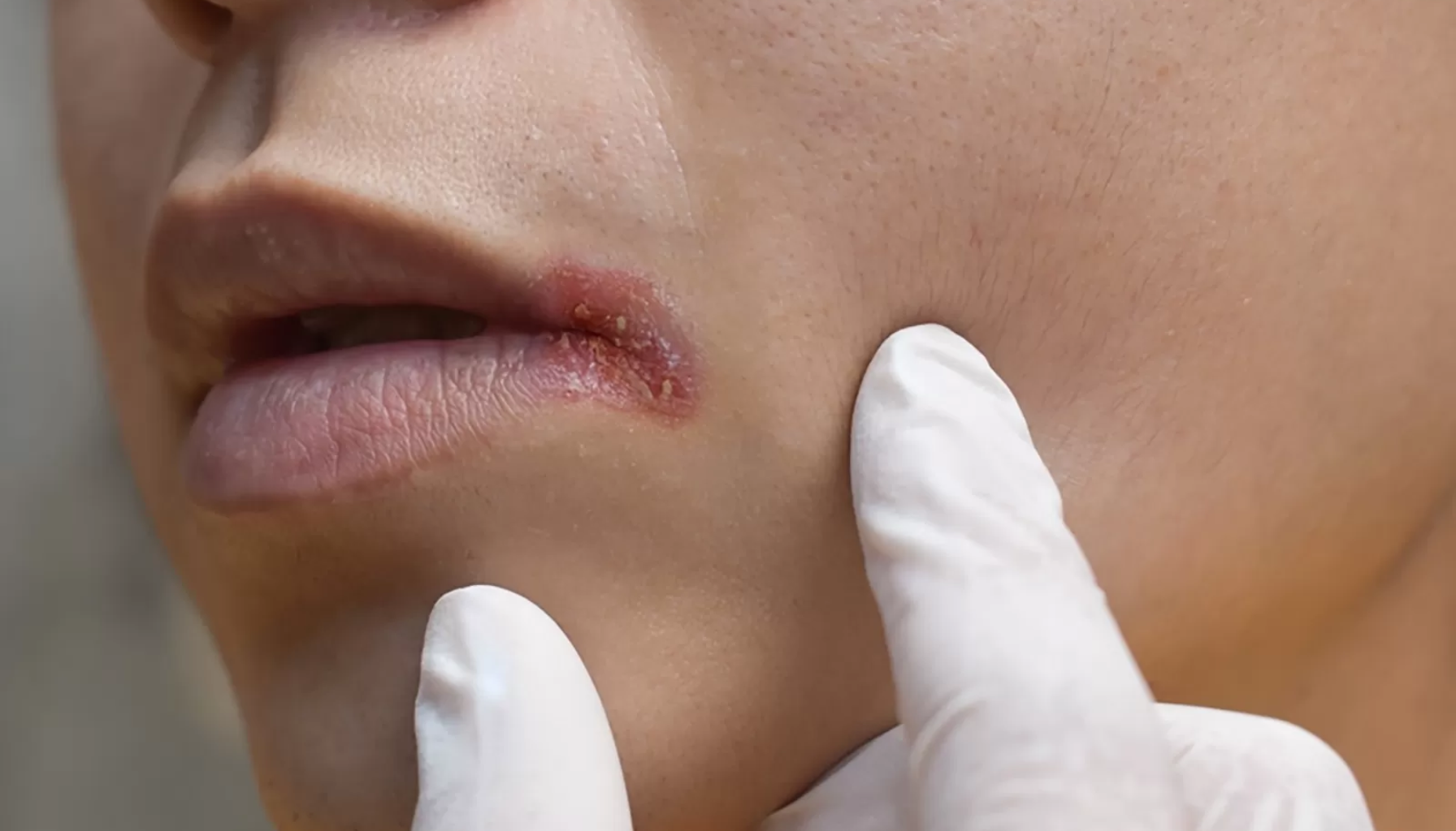 Angulær cheilitt: Sår i munnviken du ikke bør ignorere 17 "Sår og rødhet i munnviken undersøkes av helsepersonell med hvite hansker."