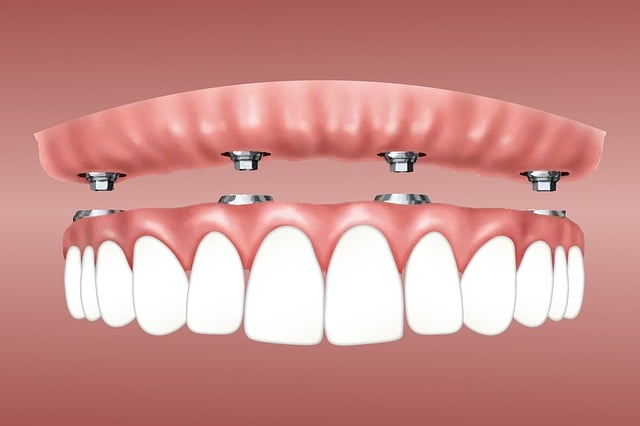 overdenture, implant, retained