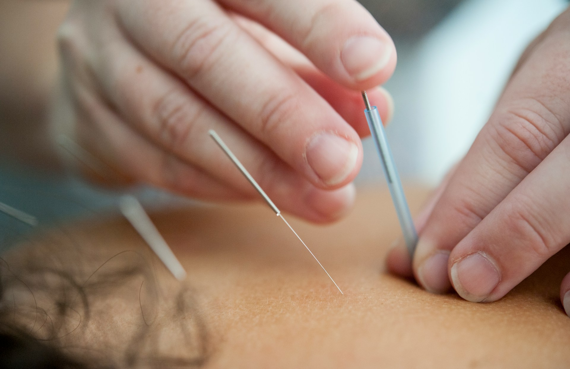 An acupuncture expert slowly and gently applying acupuncture needles during a session - https://unsplash.com/photos/person-holding-silver-and-white-pen-QgcdtM9rA5s