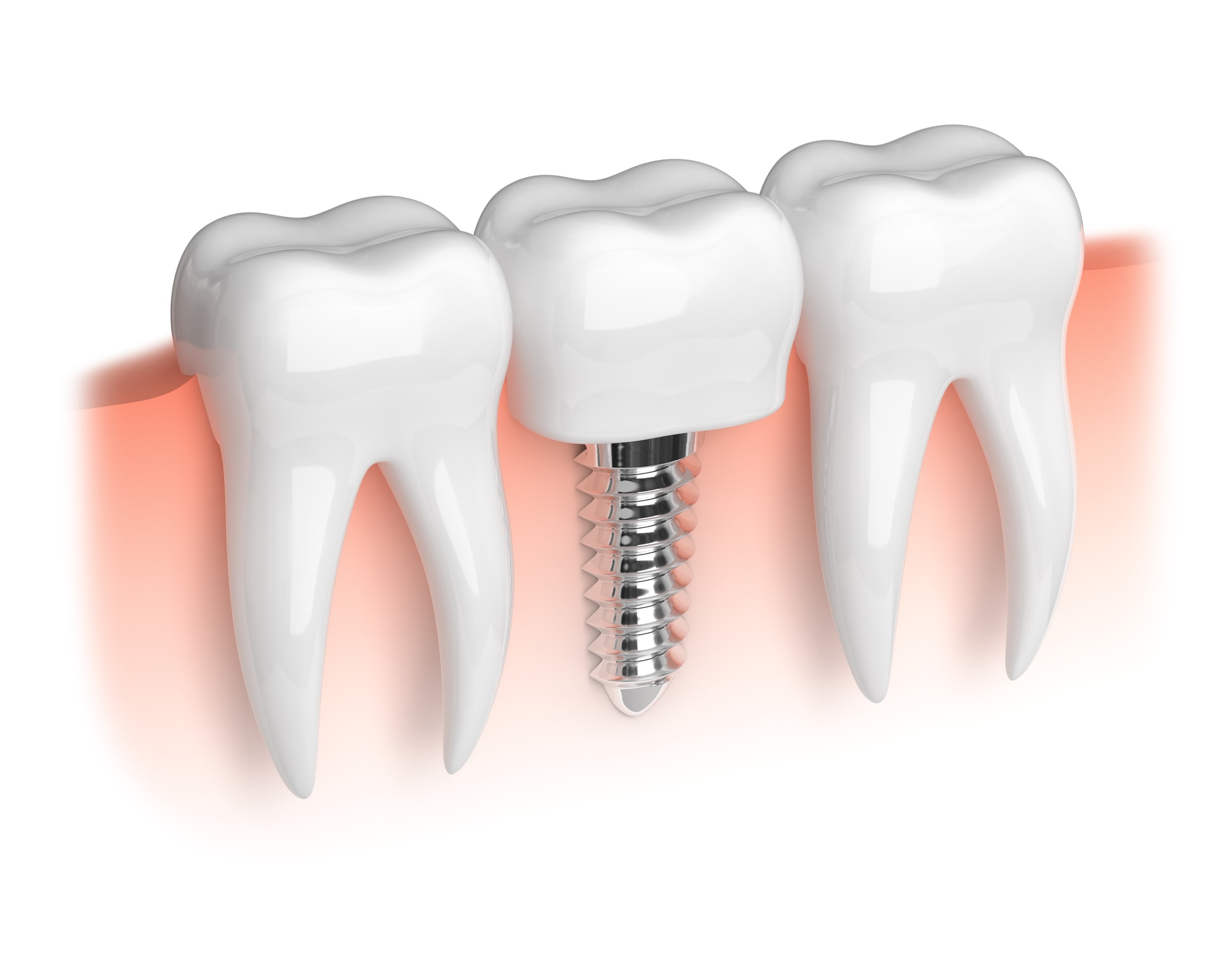 model of dental implants replacing a molar