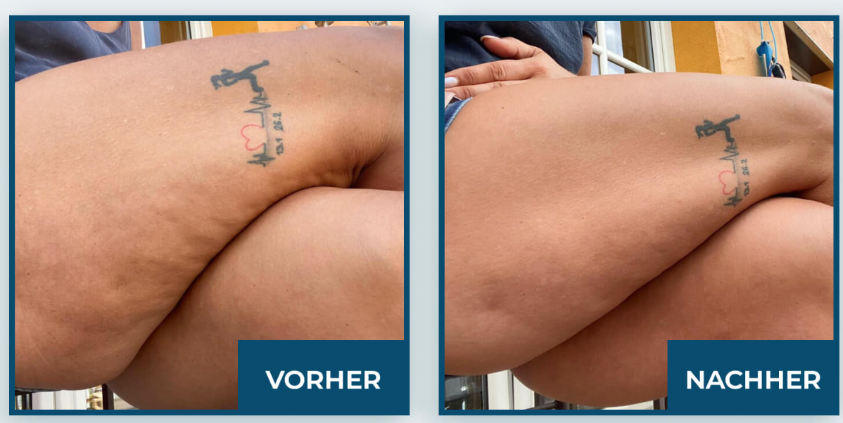 Kollagen kann bei Cellulite helfen Vorher Nachher