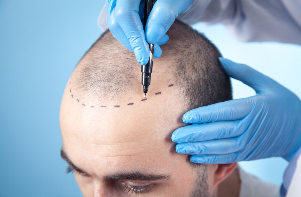 A man having his new hairline mapped ahead of a hair loss procedure