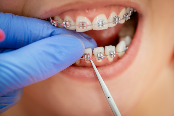 orthodontist putting braces on patients teeth