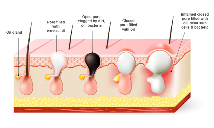 Hormonal Cyst Acne On Chin