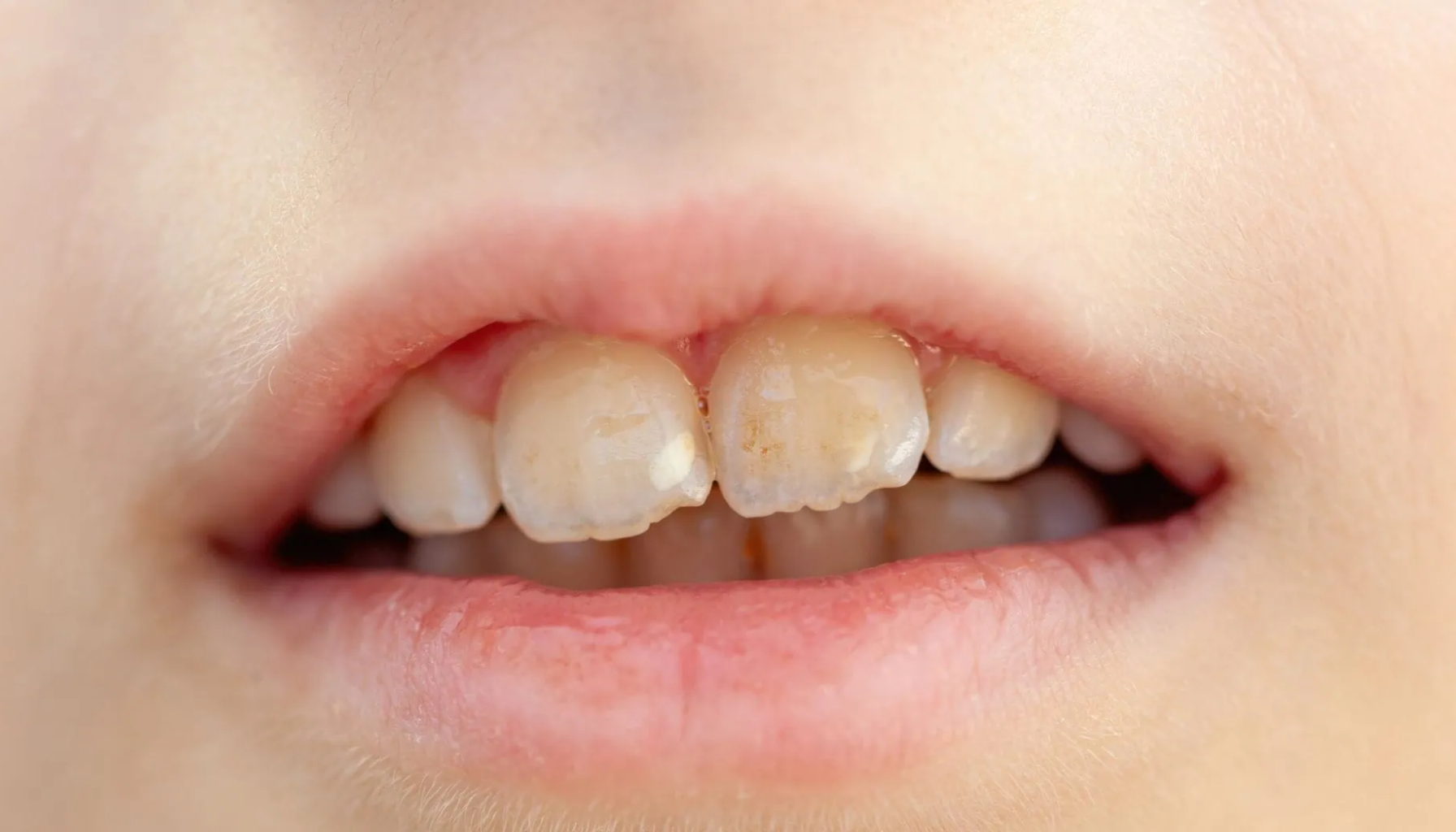 Barnets tenner med hvite flekker og begynnende emaljeskader som tegn på syrepåvirkning.