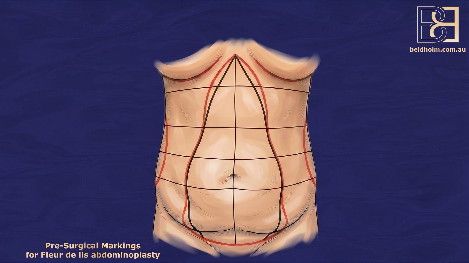 Fleur de lis Abdominoplasty Pre-surgical markings