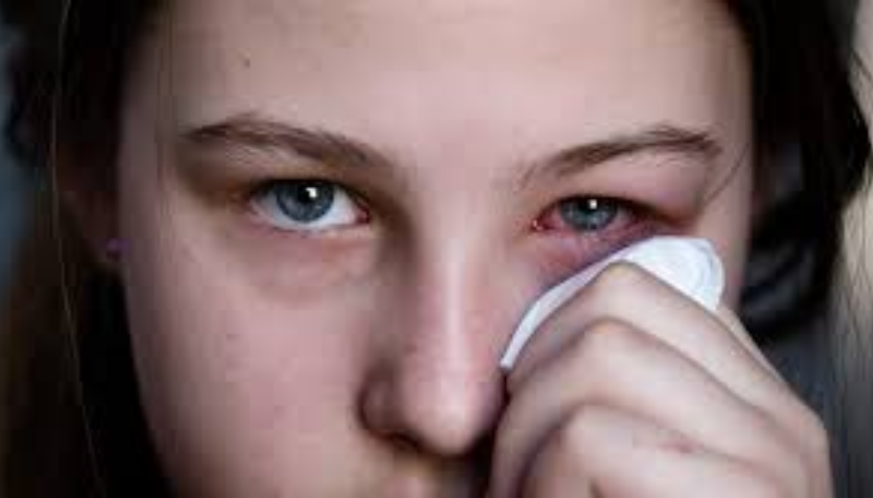 Ung kvinne med rødt og irritert øye, holder en klut forsiktig mot øyelokket.