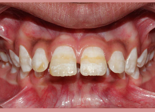 Black Stains on Teeth Causes Remedies and Treatment