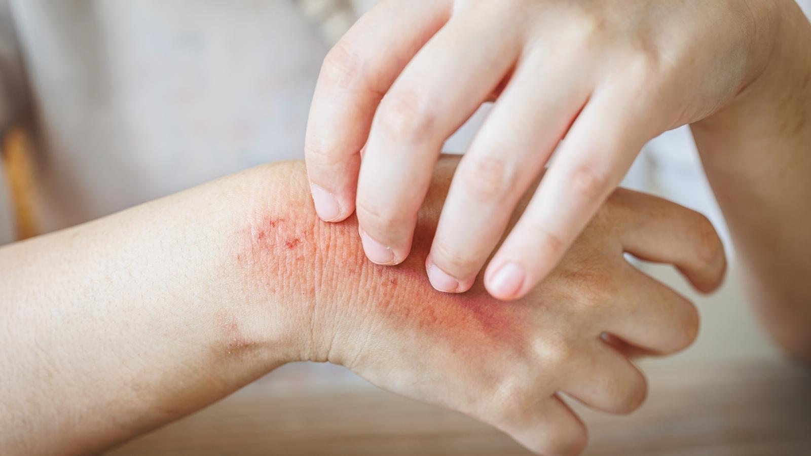 eczema and atopic dermatitis