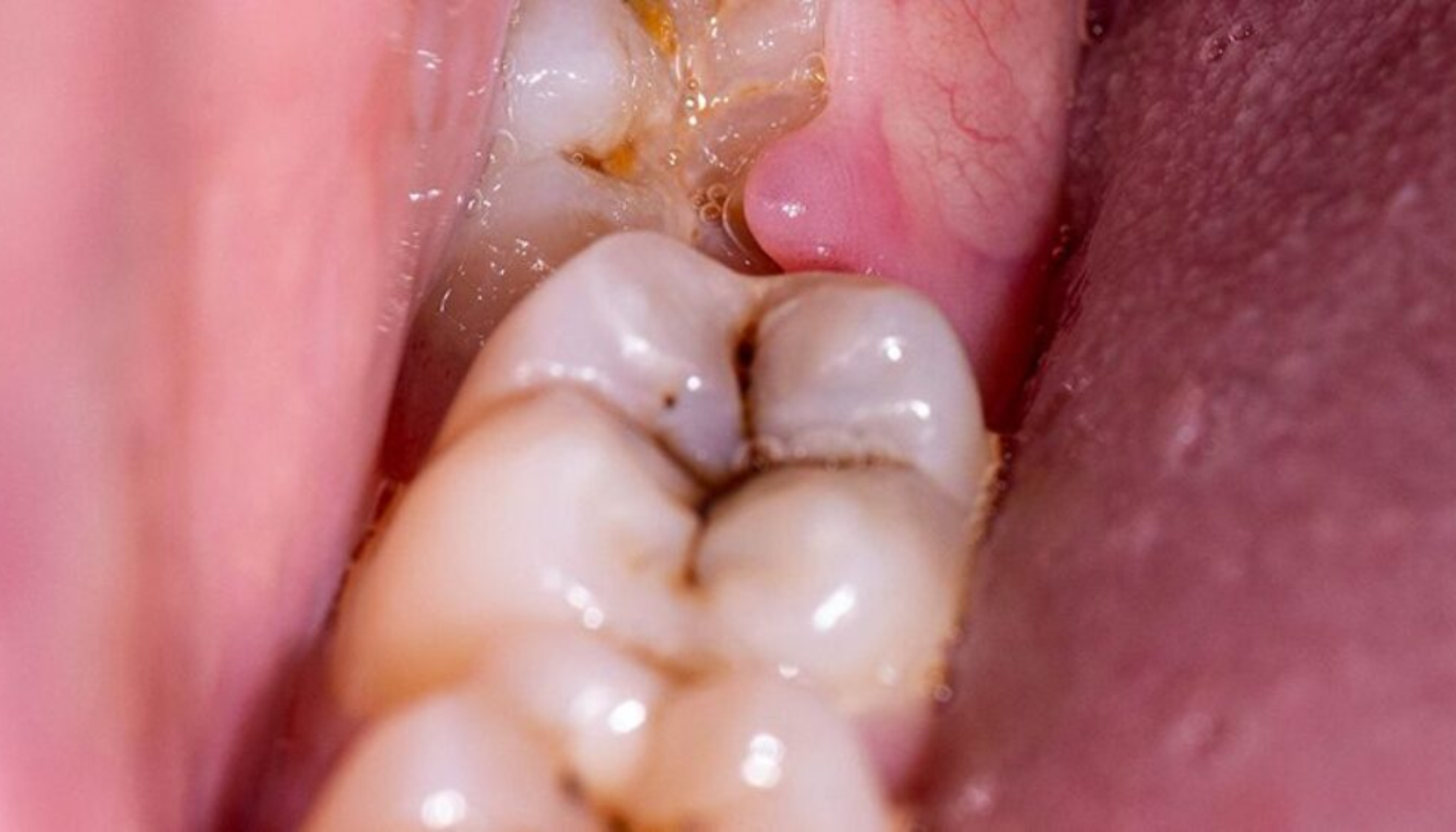 Nærbilde av visdomstann med hull og betennelse i tannkjøttet, mulig infeksjon eller delvis frembrutt tann.