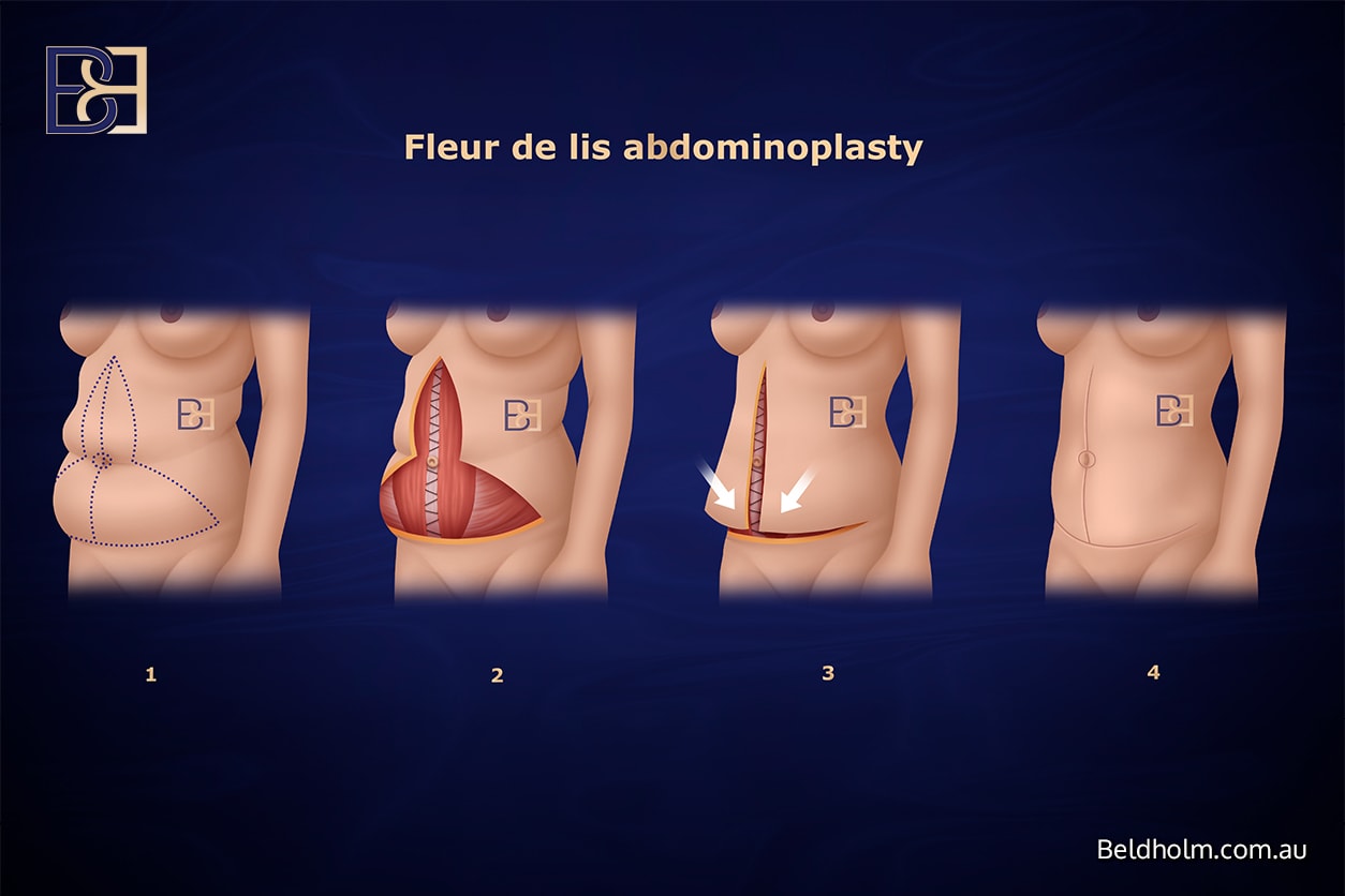 Recovering from Dual-Vector Abdominoplasty 3 Fleur de lis abdominoplasty | Dr Bernard Beldholm