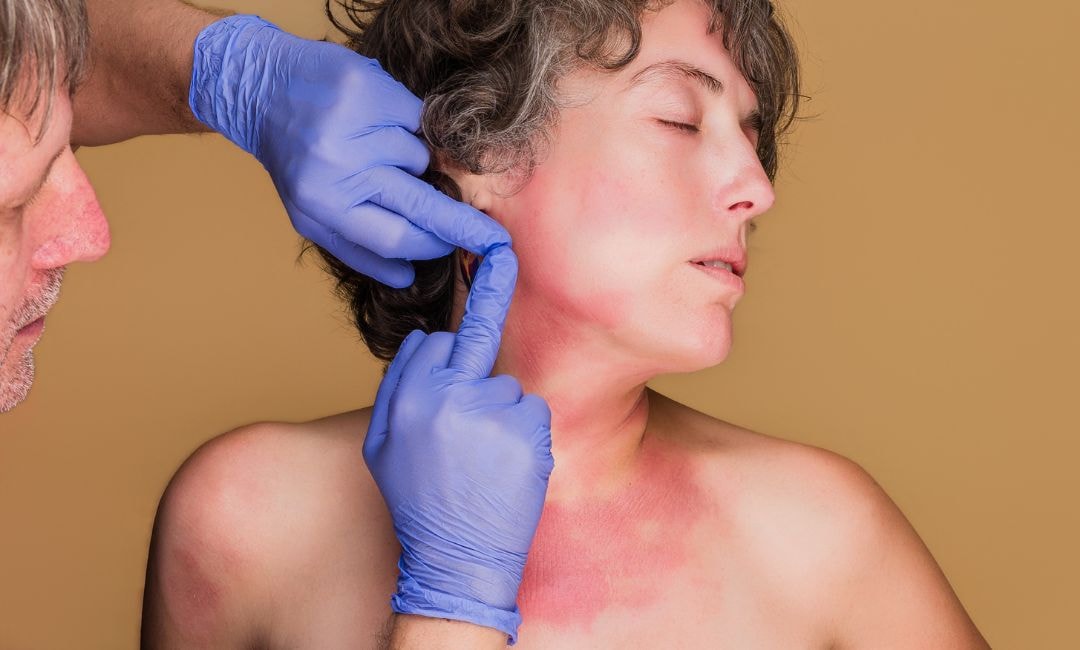 How Long Does Eczema Last | What Your Skin Is Trying to Tell