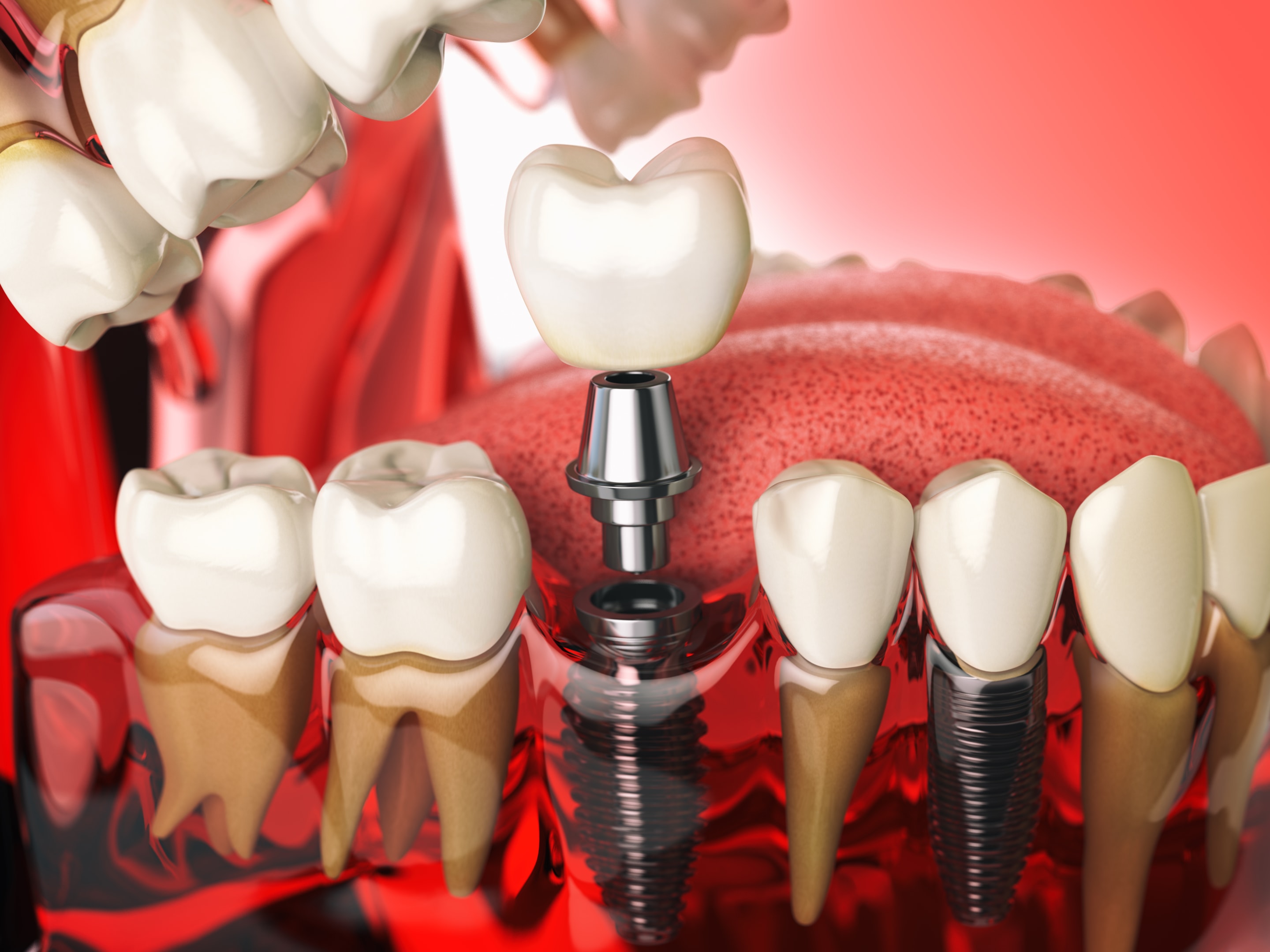 dental implant option for missing teeth