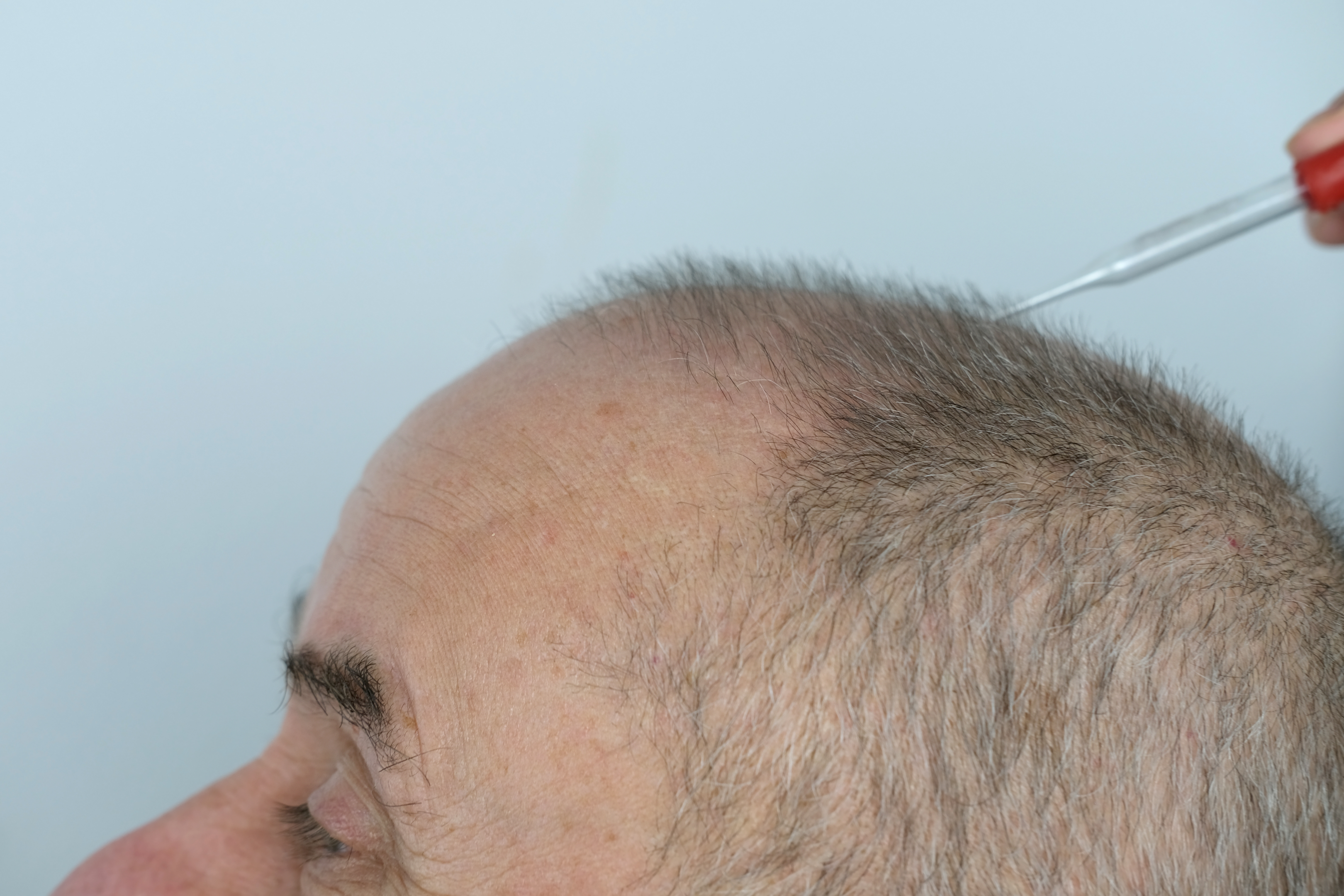 A man getting topical treatment for hair loss 