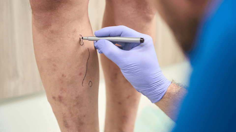 Varicose Veins