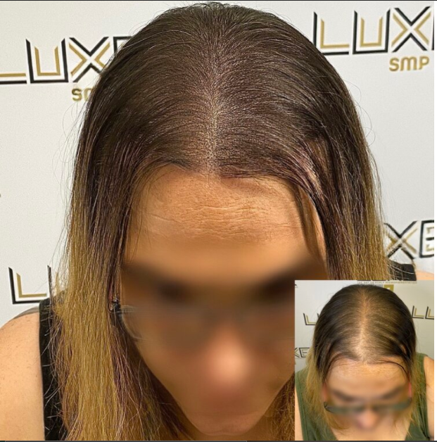 female pattern baldness before and after