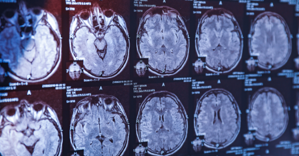 Brain dysfunction shown in a CT Scan