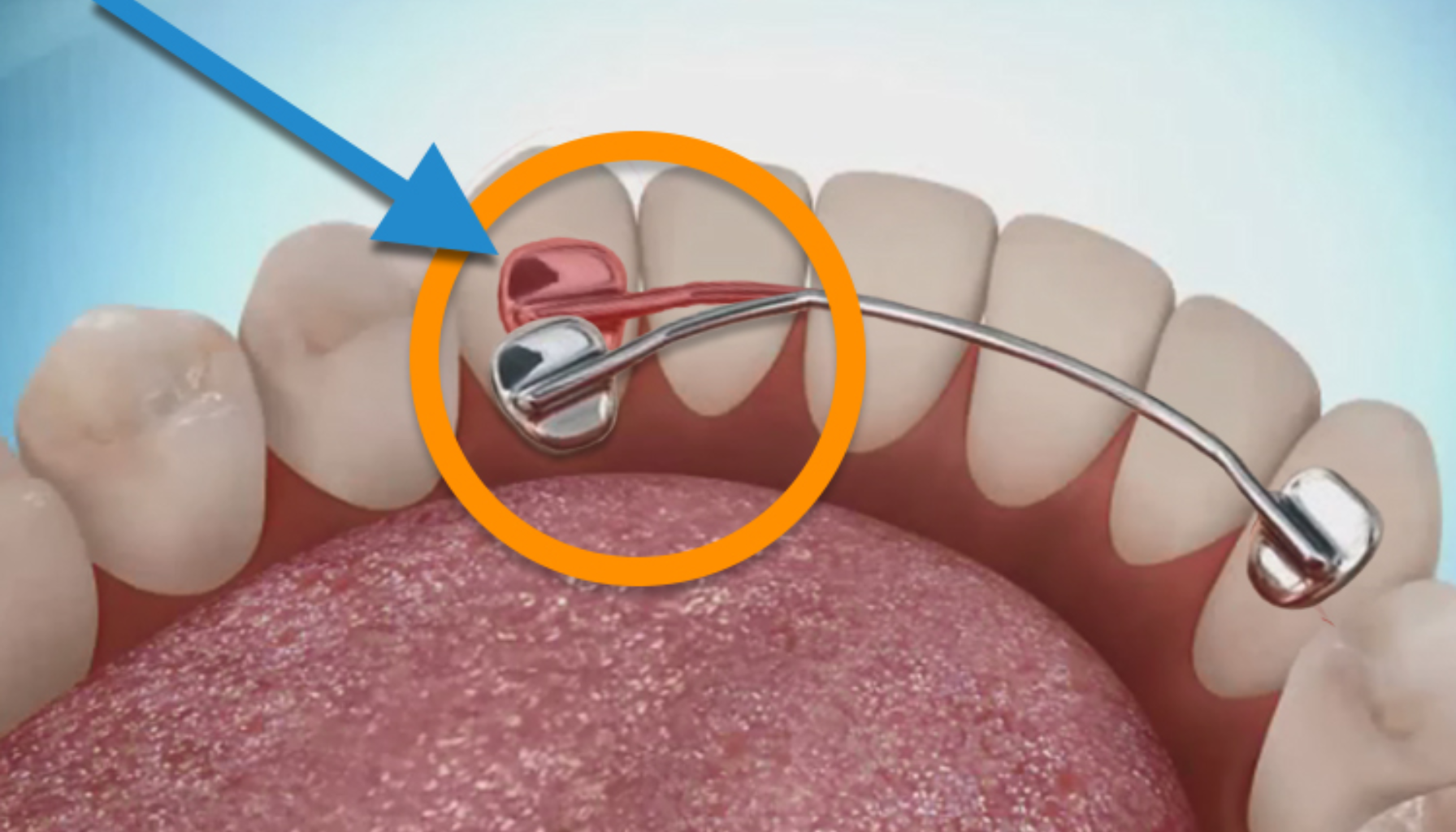 Illustrasjon av tannregulering på innsiden av tennene med metalltråd og feste markert med sirkel og pil. streng bak tennene løsnet bak tennene bak tennene løsner tennene bak streng strengen reguleringen regulering hos tannreguleringen kjeveortopeden igjen gjøre løs bruke tannlege fått tannlegen tilbake tenner nye plass løsnet hatt fjerne litt viktig time får tid behov baksiden mulig går helt bør hei beskjed kontakt hjelpe nok behandling flytte feste holde tendens dine posisjon bort løsne finne