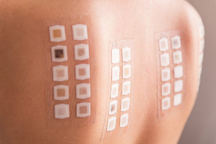 An image of small patches on the bare back of a person receiving a patch test. 