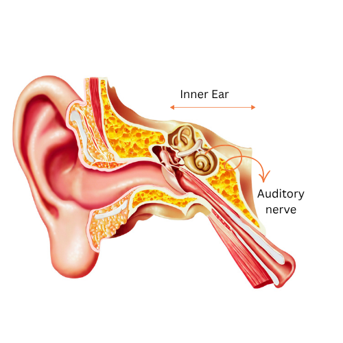 Labeled ear anatomy showing cochlea and auditory nerve damage in sensorineural hearing loss where sound reaches inner ear but processing is impaired