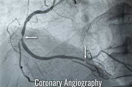  Coronary Angiogram
