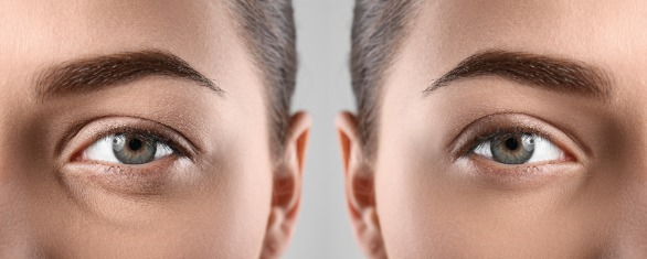 A patient undergoing upper blepharoplasty surgery to achieve a more youthful appearance
