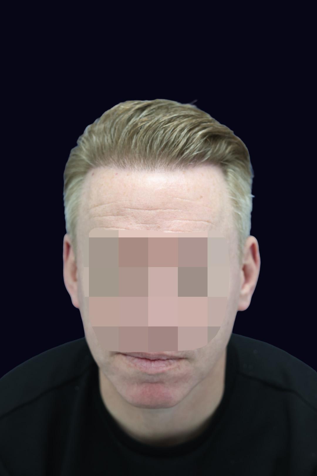Showing improvement after hair line surgery at Dr Kunnure Clinic