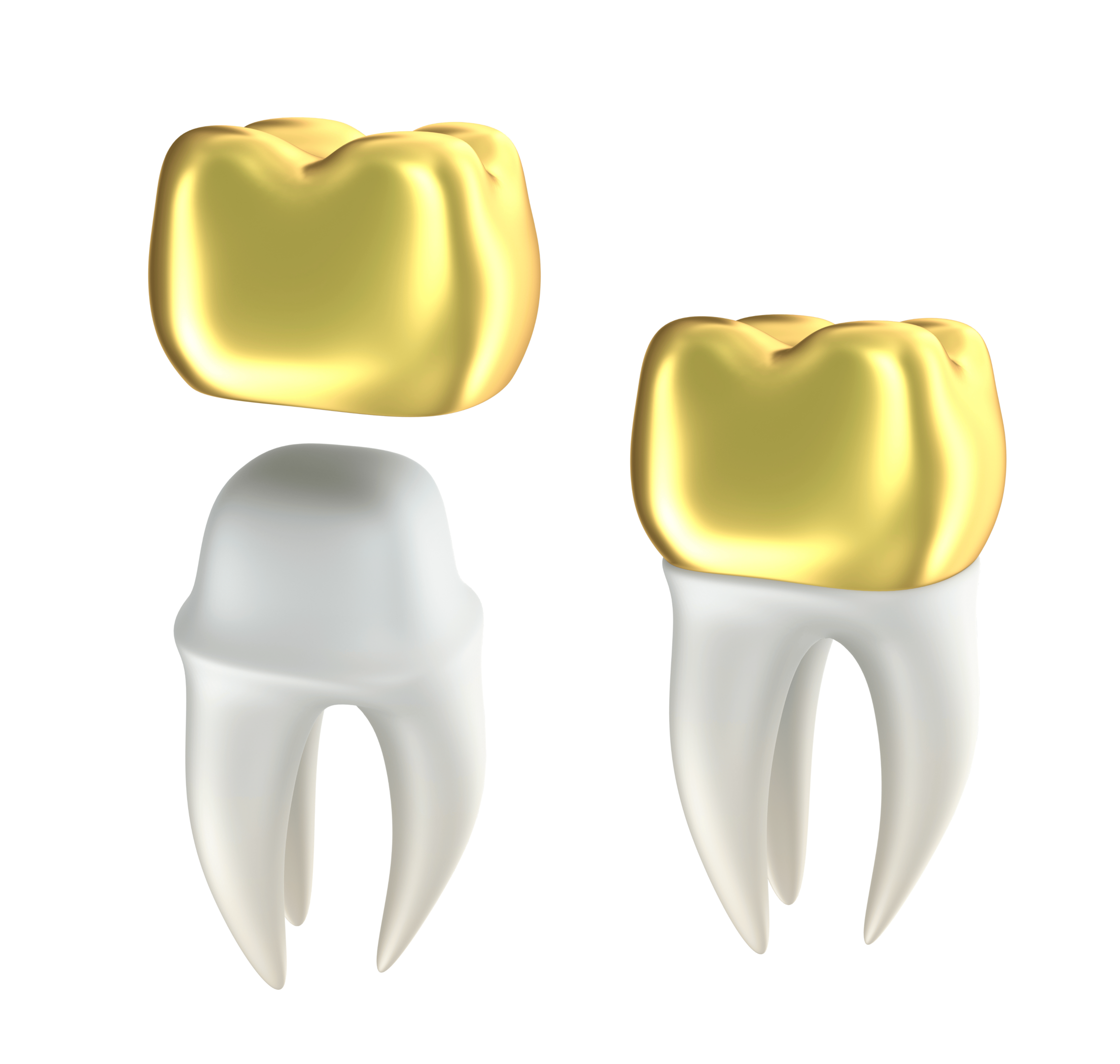 Hvis du må erstatte tannkronen din, så kan du få en i gull