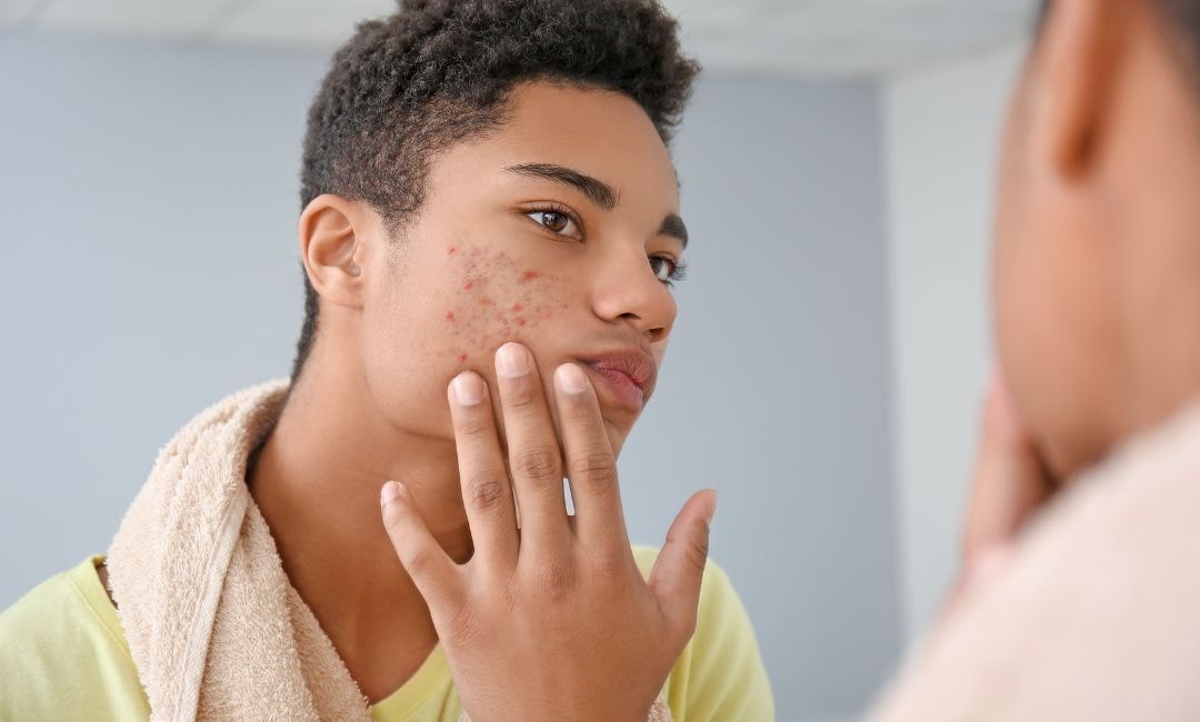 acne breakouts