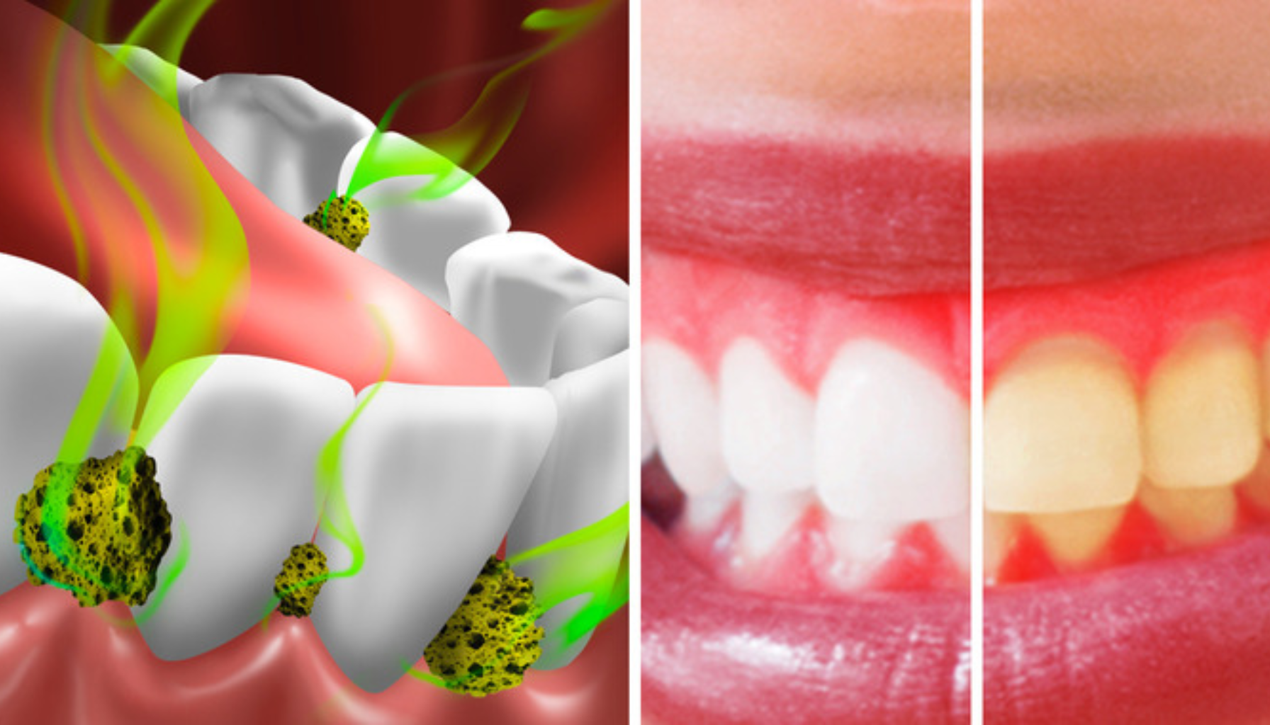 Grafisk fremstilling av dårlig ånde og tannstein, med sammenligning av sunne og misfargede tenner samt betente tannkjøttområder.
