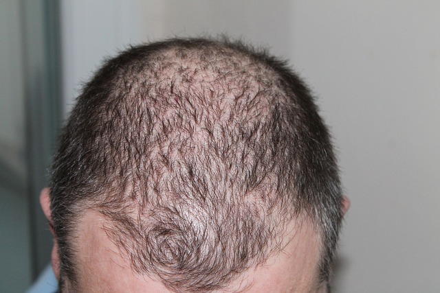 Männer Haare Diffuser Haarausfall