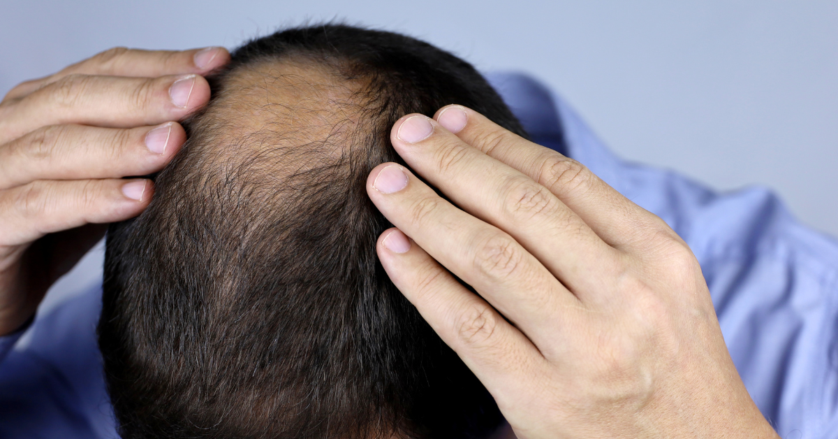 Hair loss and hormonal imbalance