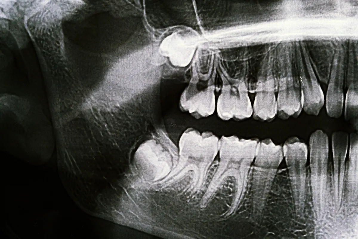 A model tooth with dental tools and a stethoscope on a blue background
