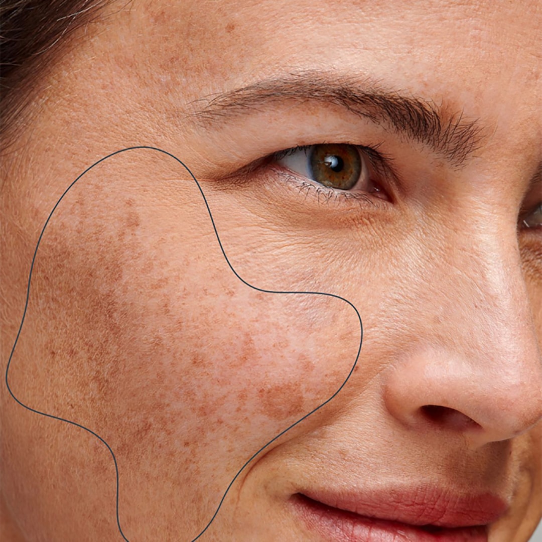 Crème tegen pigmentvlekken die donkere vlekken vermindert, pigmentvlekken lichter maakt en zorgt voor een egale huid en egale teint door actieve ingrediënten zoals vitamine C en niacinamide