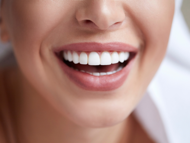 Picture showing the results of teeth bleaching.