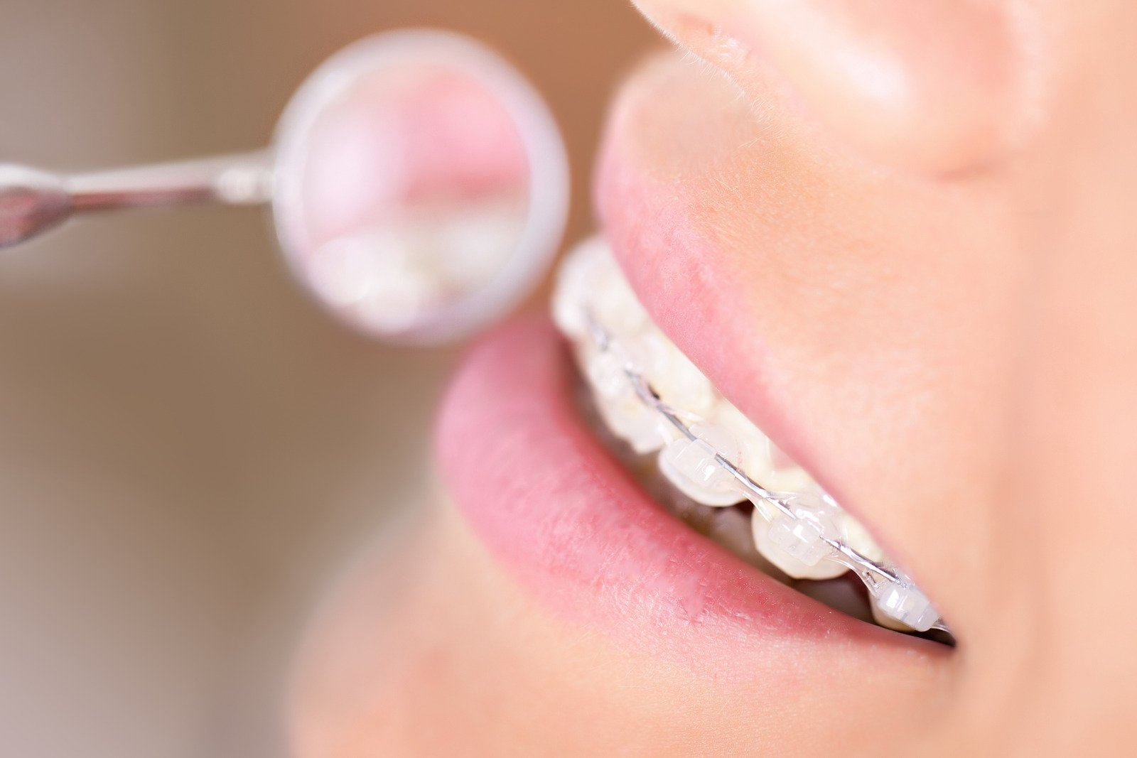 Lingual Braces: Efficacy, Cost & Comparisons