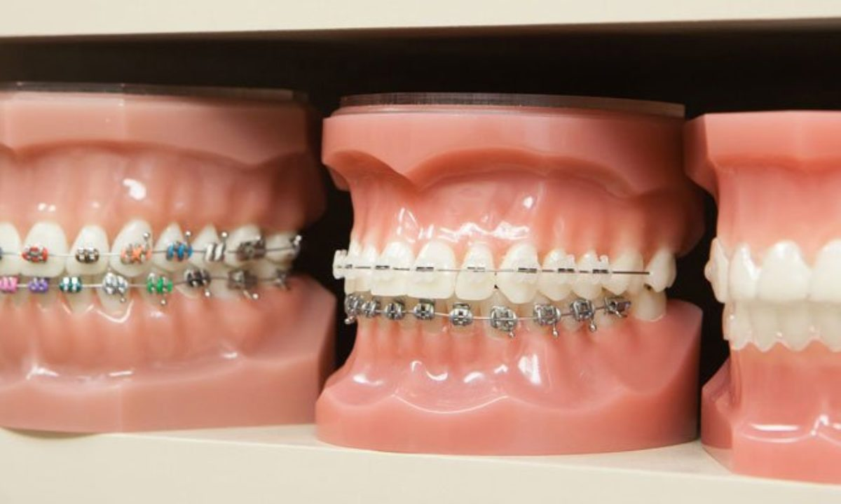 5 Common Overbite Treatment Options - NewMouth