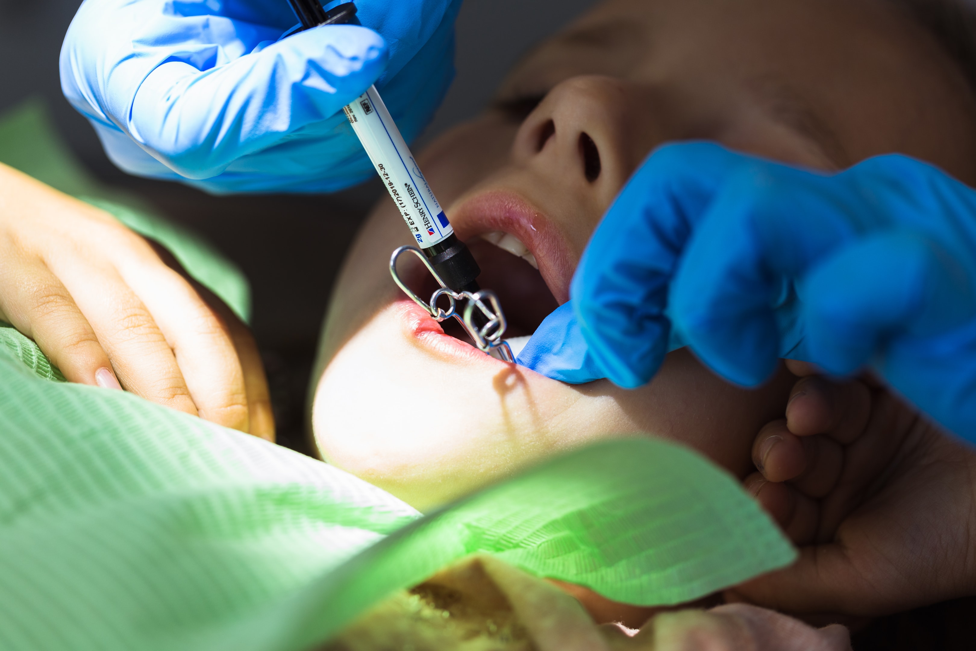 A photo of a young child during her tooth surgical extraction.