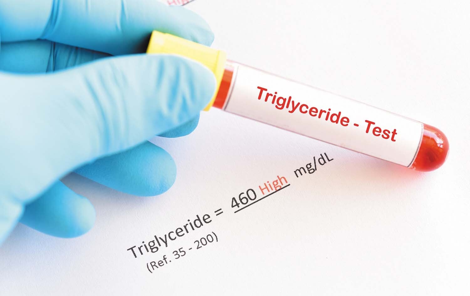 Triglyceride Levels: What Your Blood Test Numbers Say About Heart Health