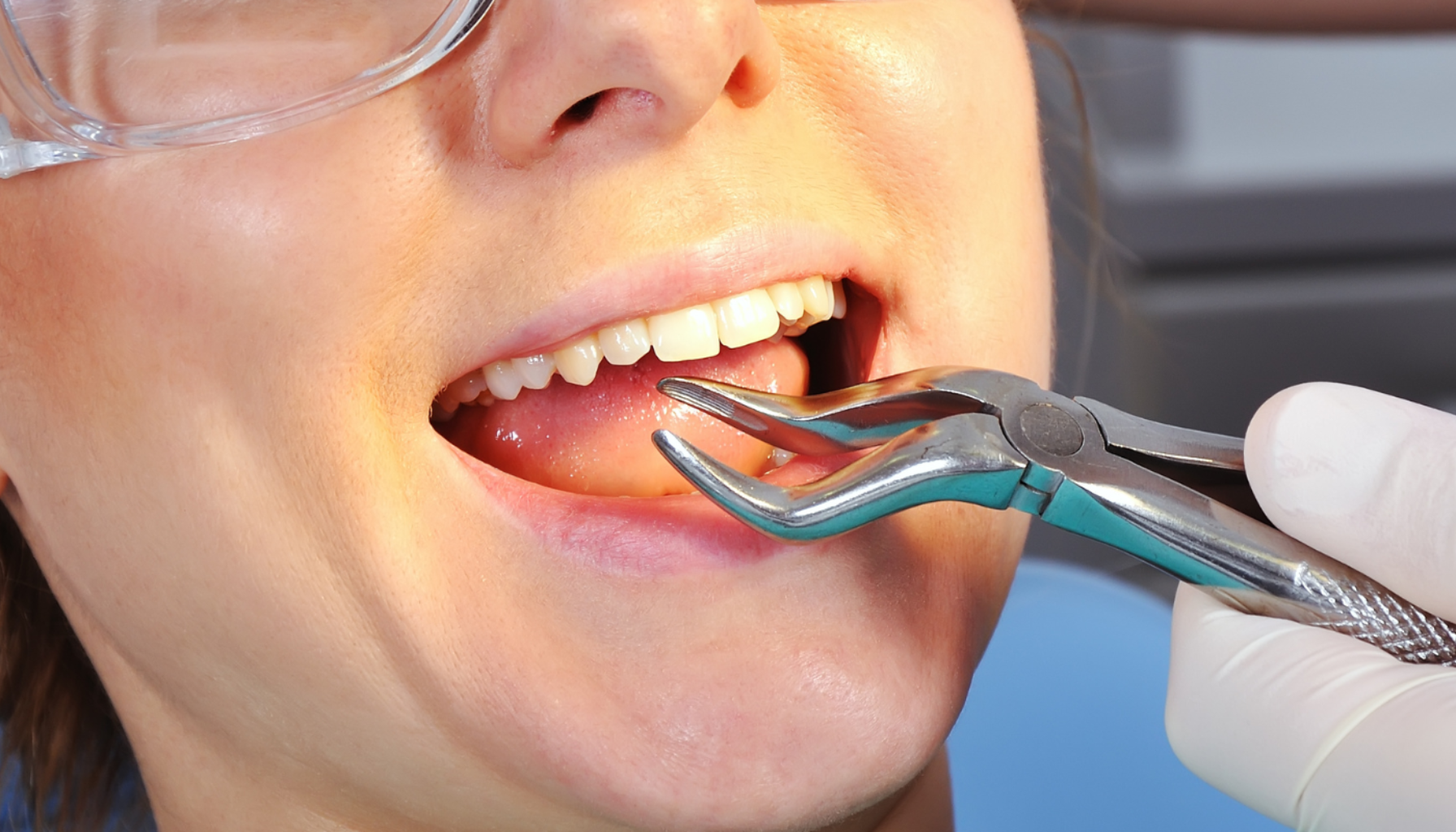 Tannlege med hansker og tang trekker tann fra pasient som bruker beskyttelsesbriller.